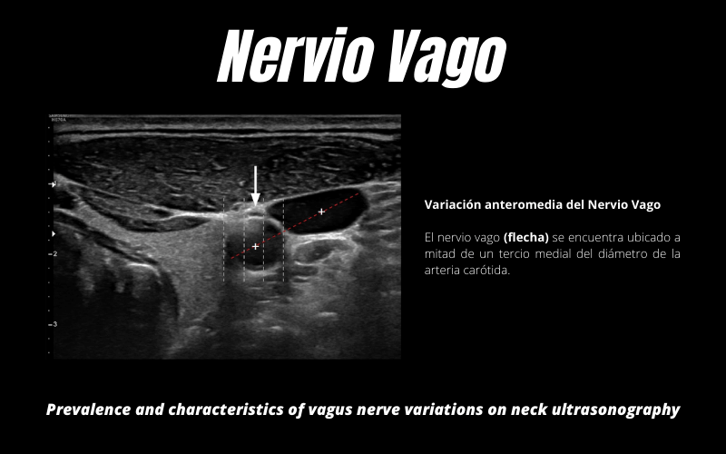 4. Nervio Vago Ecografia Articulo.png